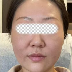 Radiesse Before & After Patient #2370