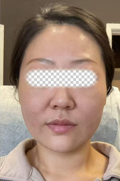 Radiesse Before & After Patient #2370