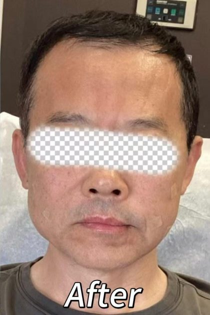 Collagen Volume Before & After Patient #2371