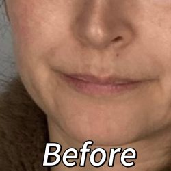 Lip Filler Before & After Patient #2372