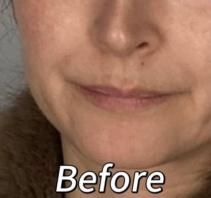 Lip Filler Before & After Patient #2372