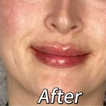 Lip Filler Before & After Patient #2372