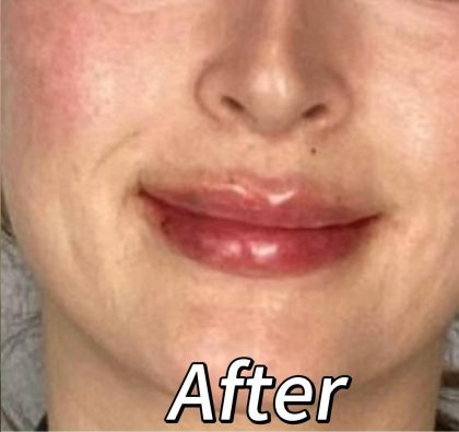 Lip Filler Before & After Patient #2372