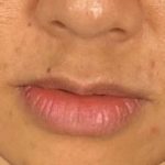 Lip Filler Before & After Patient #2373
