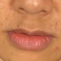 Lip Filler Before & After Patient #2373