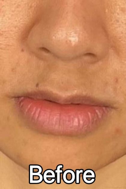 Lip Filler Before & After Patient #2373