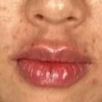 Lip Filler Before & After Patient #2373