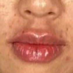 Lip Filler Before & After Patient #2373