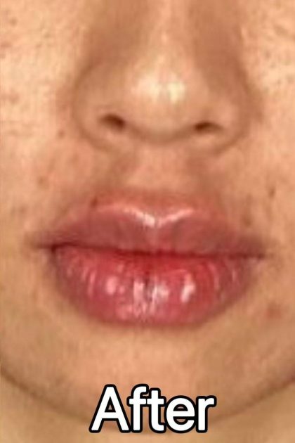 Lip Filler Before & After Patient #2373
