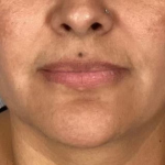 Lip Filler Before & After Patient #2382