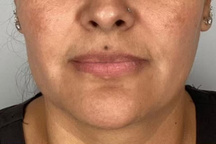 Lip Filler Before & After Patient #2382