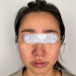 Jawline Filler Before & After Patient #2389