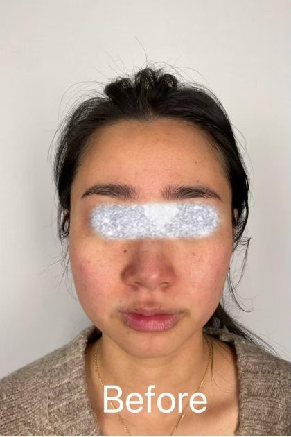 Jawline Filler Before & After Patient #2389