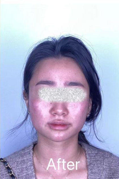 Jawline Filler Before & After Patient #2389