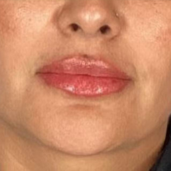 Lip Filler Before & After Patient #2382