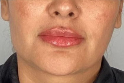 Lip Filler Before & After Patient #2382
