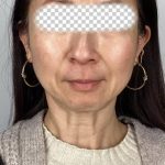 Lip Filler Before & After Patient #2571