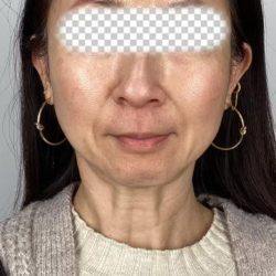 Lip Filler Before & After Patient #2571