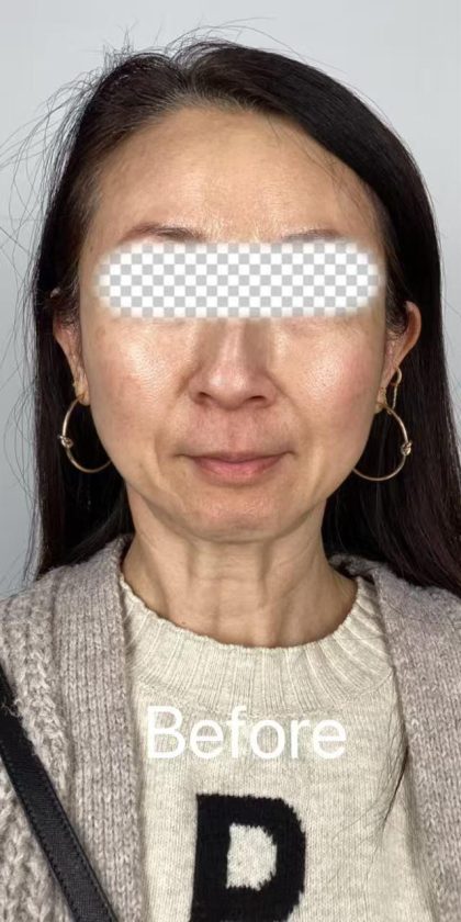 Lip Filler Before & After Patient #2571