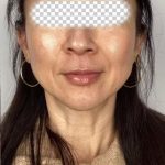 Lip Filler Before & After Patient #2571