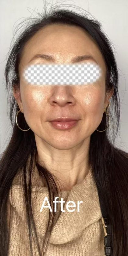 Lip Filler Before & After Patient #2571