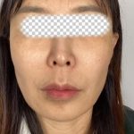 Collagen Volume Before & After Patient #2572