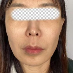 Collagen Volume Before & After Patient #2572