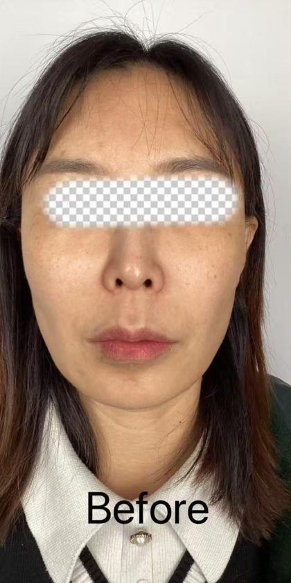 Collagen Volume Before & After Patient #2572