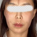 Collagen Volume Before & After Patient #2572