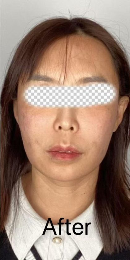 Collagen Volume Before & After Patient #2572