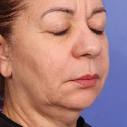 XERF Before & After Patient #2657
