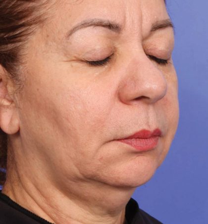XERF Before & After Patient #2657