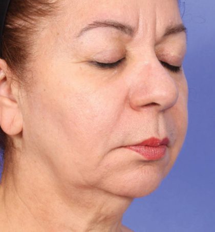 XERF Before & After Patient #2657