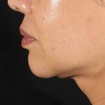 XERF Before & After Patient #2660