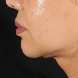 XERF Before & After Patient #2660