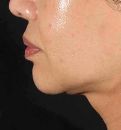 XERF Before & After Patient #2660