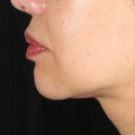 XERF Before & After Patient #2660