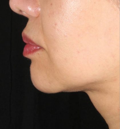 XERF Before & After Patient #2660