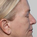 XERF Before & After Patient #2661