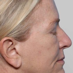 XERF Before & After Patient #2661