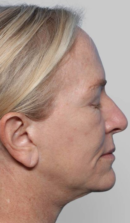 XERF Before & After Patient #2661