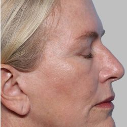 XERF Before & After Patient #2661