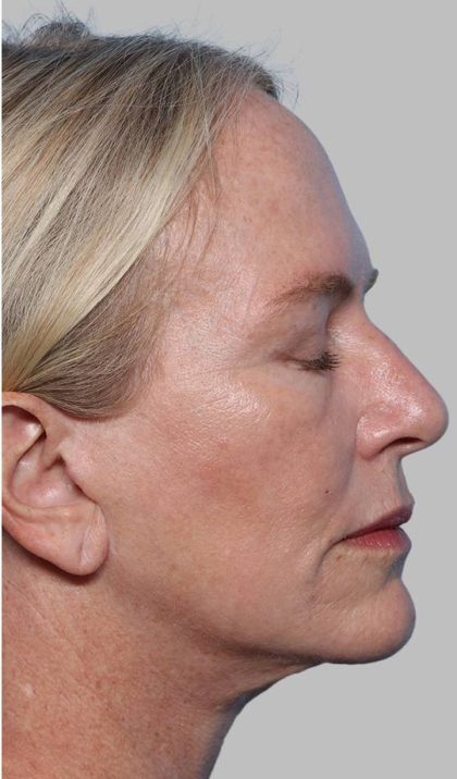 XERF Before & After Patient #2661
