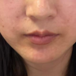 Lip Filler Before & After Patient #2676