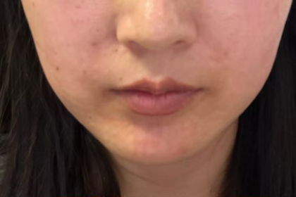 Lip Filler Before & After Patient #2676