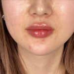Lip Filler Before & After Patient #2676