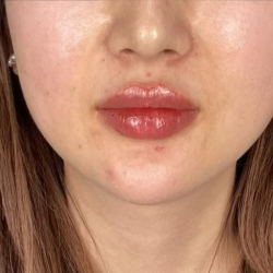 Lip Filler Before & After Patient #2676