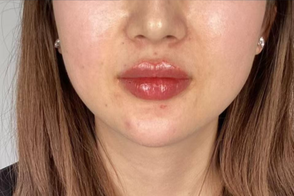 Lip Filler Before & After Patient #2676