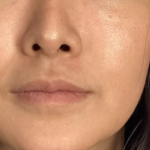Lip Filler Before & After Patient #2677
