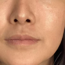 Lip Filler Before & After Patient #2677